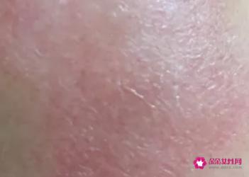 脸过敏发红痒起小疙瘩怎么办