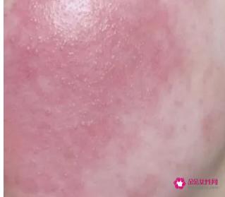 脸过敏发红痒起小疙瘩怎么办