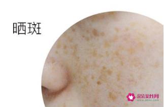 黄褐斑与晒斑最直观区别图片