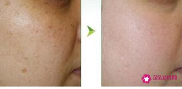 黄褐斑与晒斑最直观区别图片