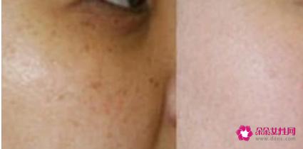 黄褐斑与晒斑最直观区别图片
