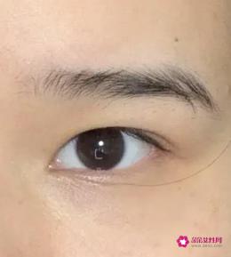 什么是内双眼皮