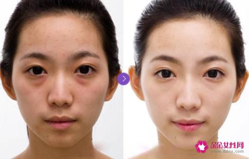 水光针的主要功效和副作用