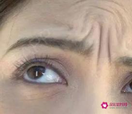 皮肤皱纹是什么原因