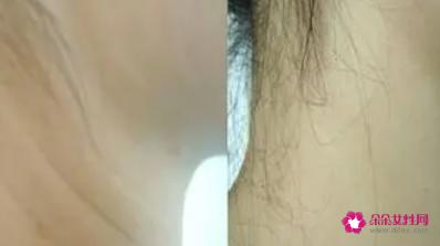 颈纹去除术一般多少钱