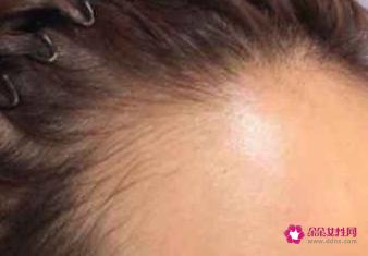 如何让发际线慢慢变低