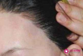 如何让发际线慢慢变低