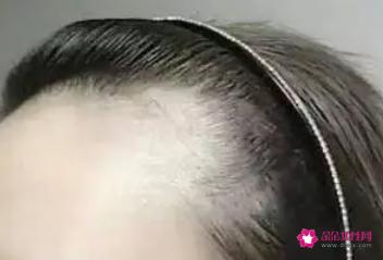 如何让发际线慢慢变低