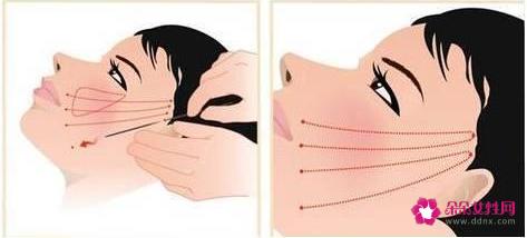 全脸除皱用什么