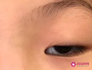 眼皮松弛做什么手术好