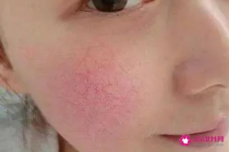 有红血丝的皮肤怎么保养