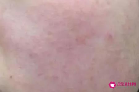 有红血丝的皮肤怎么保养