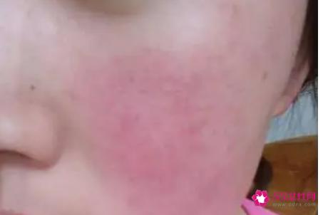 有红血丝的皮肤怎么保养