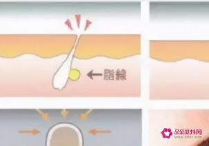 毛孔里面总有挤不完的油脂粒