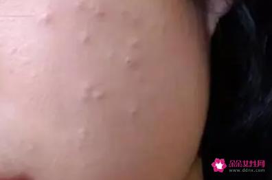如何不长青春痘