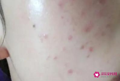 如何不长青春痘