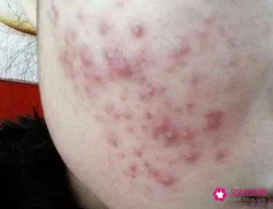 如何不长青春痘
