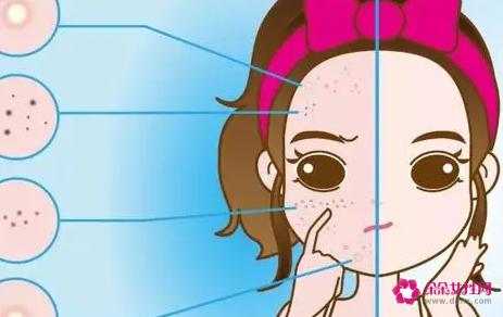 镭射祛斑好不好