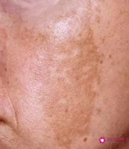 蝴蝶斑和黄褐斑的区别是什么