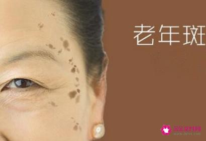 去除老年斑小偏方
