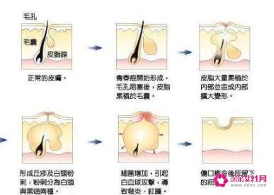 脸颊两边反复长痘痘是什么原因引起的