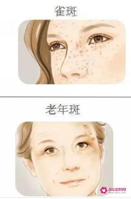 黄褐斑怎么去除最有效的方法有哪些