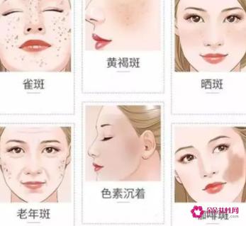 黄褐斑怎么去除最有效的方法有哪些