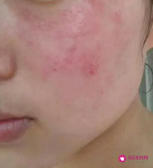 皮肤发红怎么解决