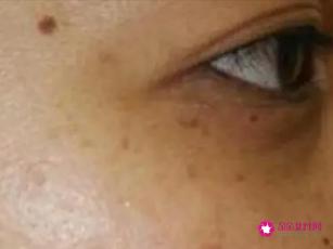 眼周的色斑怎样祛除