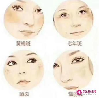 斑是怎么形成的有几种原因