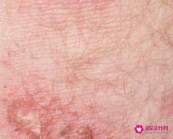 斑是怎么形成的有几种原因