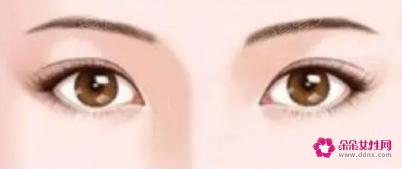 双眼皮的种类