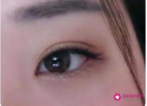 双眼皮的种类