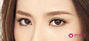 双眼皮的种类