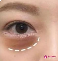 眼睛填充用什么填充最好