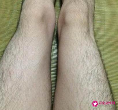 简单有效的脱毛小偏方