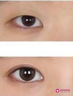 上眼皮松弛恢复锻炼法