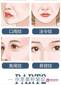 鱼尾纹可以手术切除吗