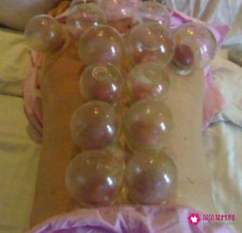 刮痧后可以直接拔罐吗