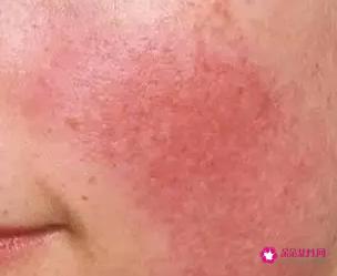 敏感肌应该怎么护理