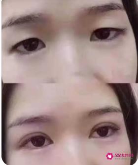 单眼皮比双眼皮有什么好处