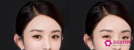 单眼皮比双眼皮有什么好处