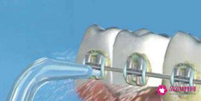 洗牙齿有什么好处和坏处