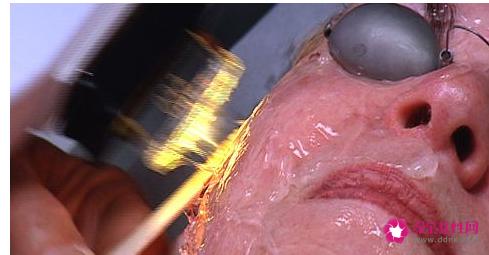 光子嫩肤可不可以美白