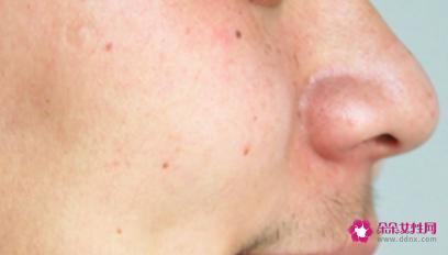 老年斑形成的原因是什么