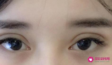 欧式大双和普通双眼皮