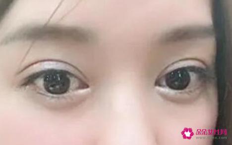 欧式大双和普通双眼皮