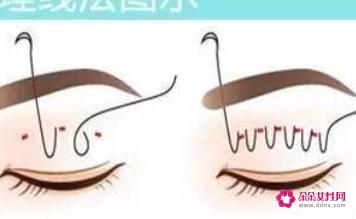 欧式大双和普通双眼皮