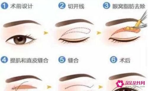 欧式大双和普通双眼皮