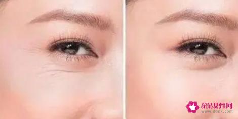 6个小妙招轻松去掉鱼尾纹